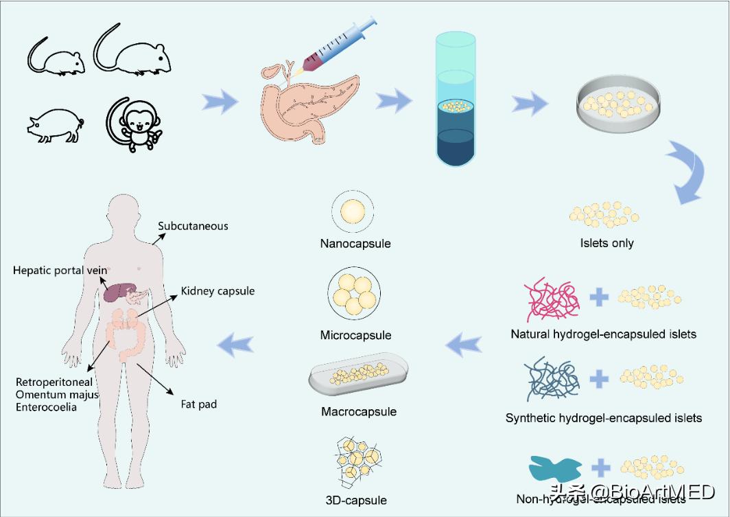胰岛移植治疗1型糖尿病的前景,糖尿病胰岛细胞再生修复治疗