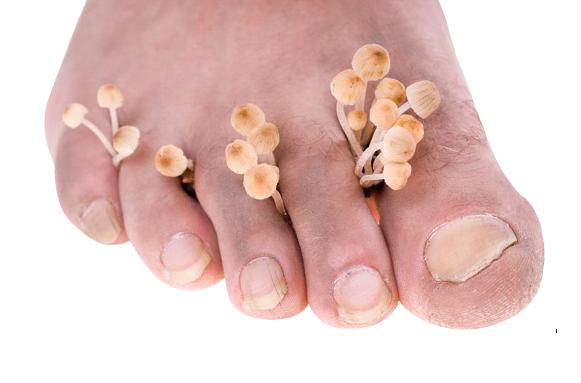 日本人如何处理脚气问题,欧美人为什么更容易患脚气