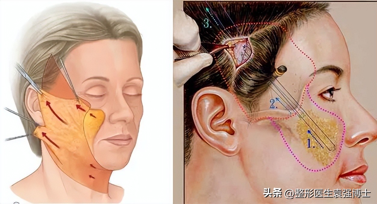 拉皮基础知识,关于拉皮的知识