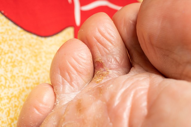 治脚气脚痒脱皮起泡的药材,什么草药治脚气长水泡痒