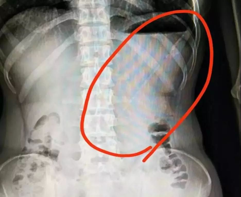 误吞牙签怎么办,少年误吞牙签一个小妙招