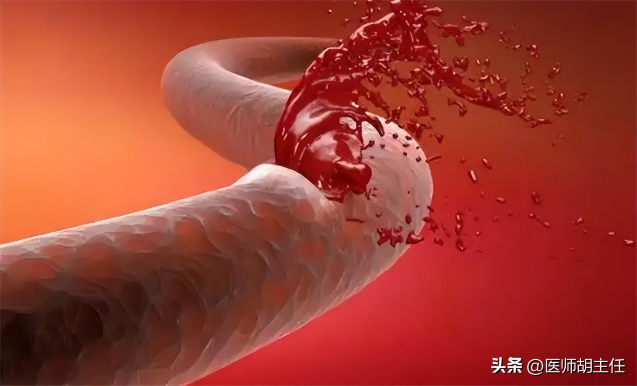 做冠状动脉造影对人体有副作用吗,做完冠脉造影后血管会变脆吗