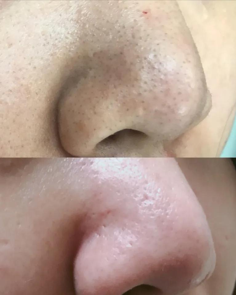 鼻子黑头里挤出的白色油脂怎么办,鼻子上有硬硬的黑头怎么办