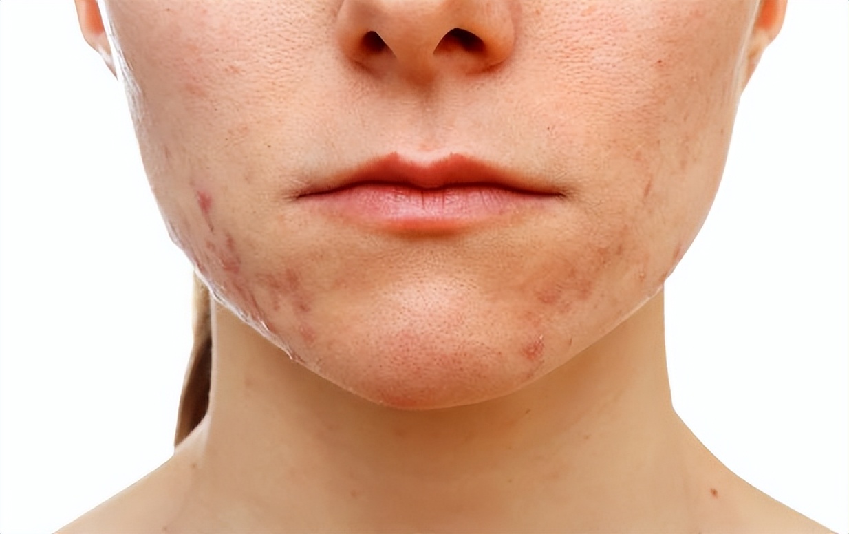 治疗痘印最有效的医美手段,脸部痘印中医能治疗嘛