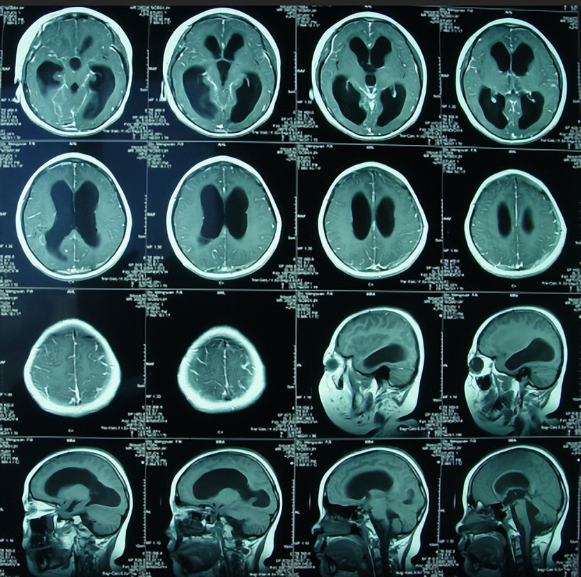 儿童结核脑膜炎脑积水,结核性脑膜炎脑积水如何引起