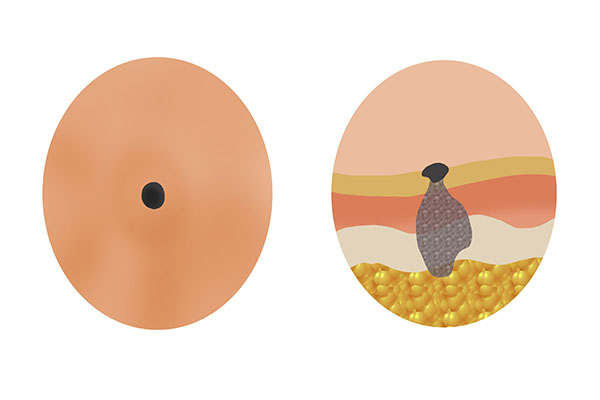 长在身体哪些部位的痣要特别注意,身上长的痣哪一种痣最危险