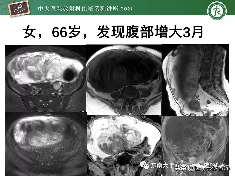 卵巢浆液性肿瘤的肉眼及镜下特征,卵巢原发性粘液性囊腺瘤
