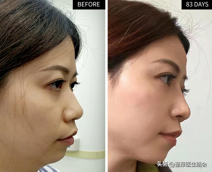 隆鼻到底要不要只做鼻头,隆鼻前要检查哪些项目