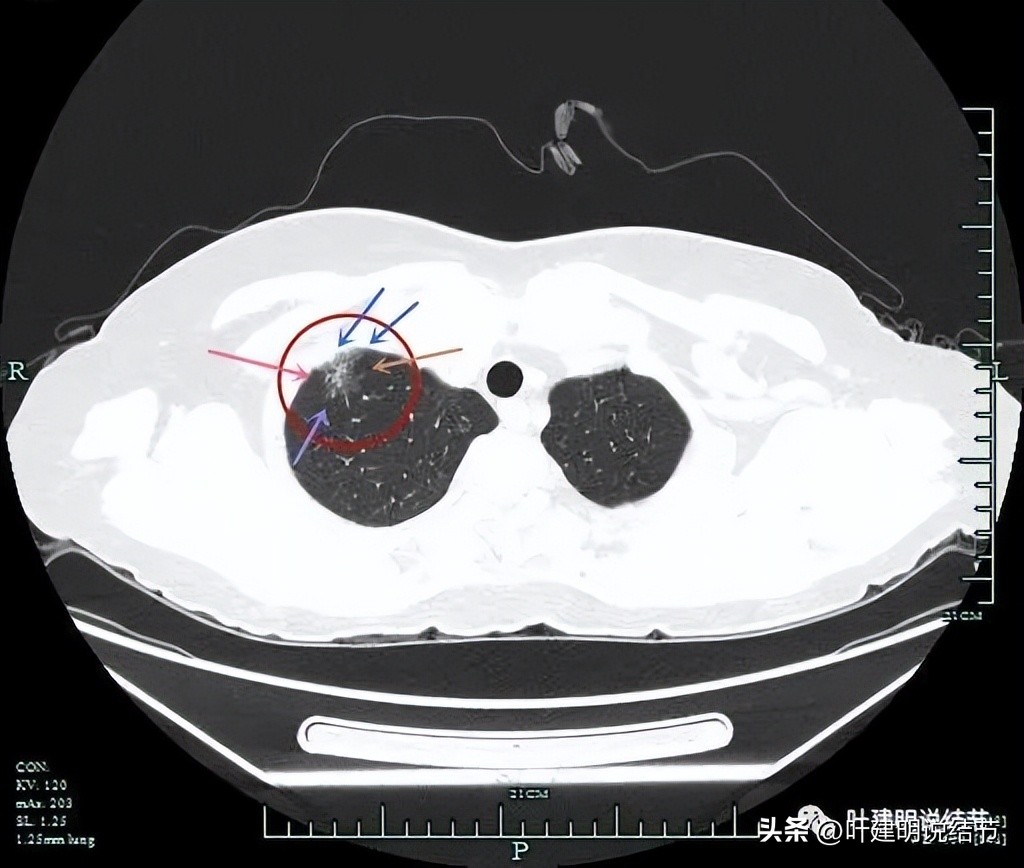 肺癌病理的肿块是硬的吗,肺癌病灶什么样