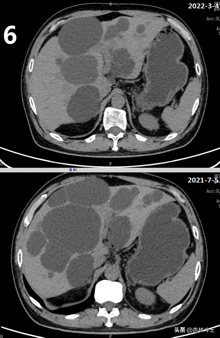 64岁银行职员患肝囊肿,CT引导下细针穿刺抽吸酒精硬化解决大问题