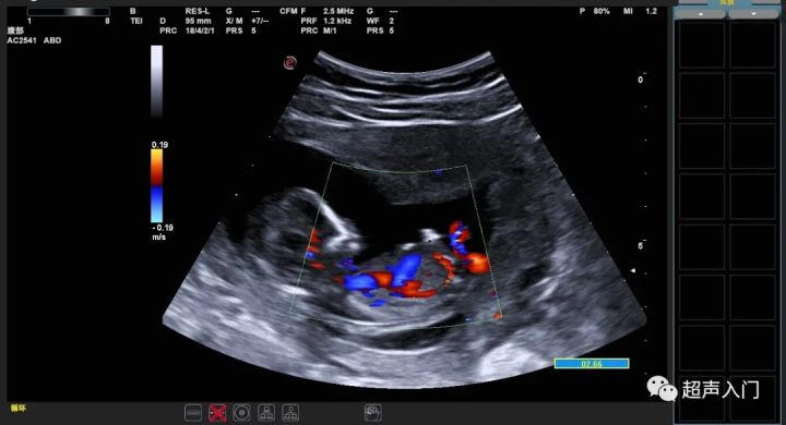 nt检查是阴式还是腹式彩超,nt是做阴超还是腹部超声啊