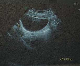 左侧卵巢囊肿会引起哪些不适,卵巢囊肿8cm左右无不适症状要紧吗