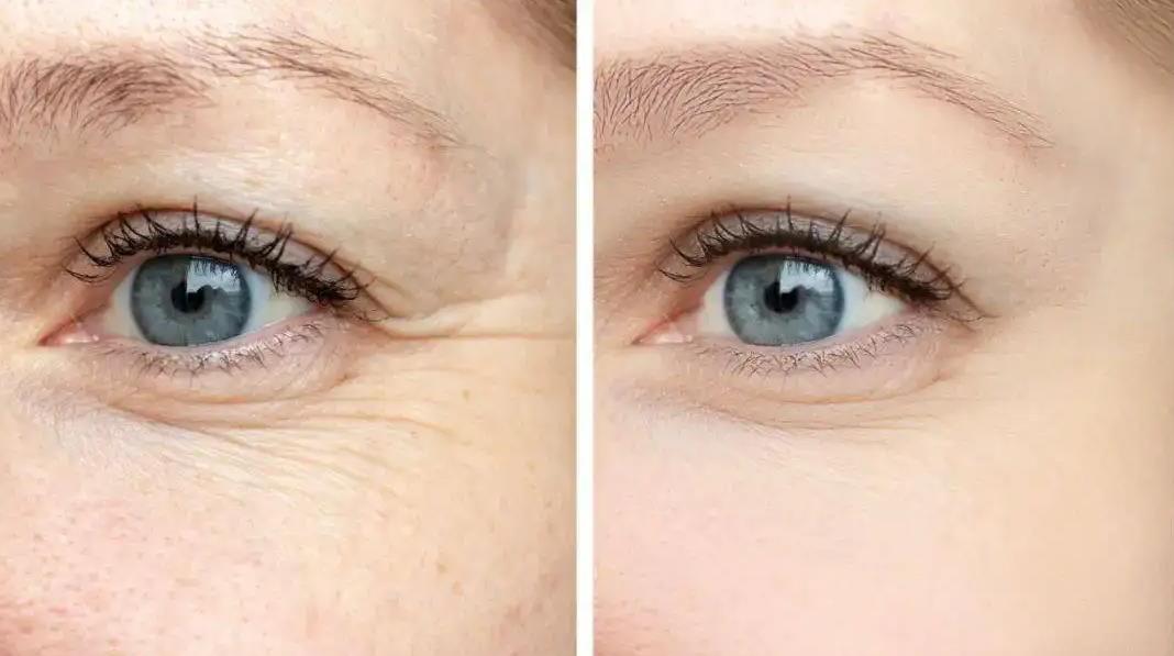 脸上皱纹越来越多教你一个好方法,脸部皱纹多怎么解释