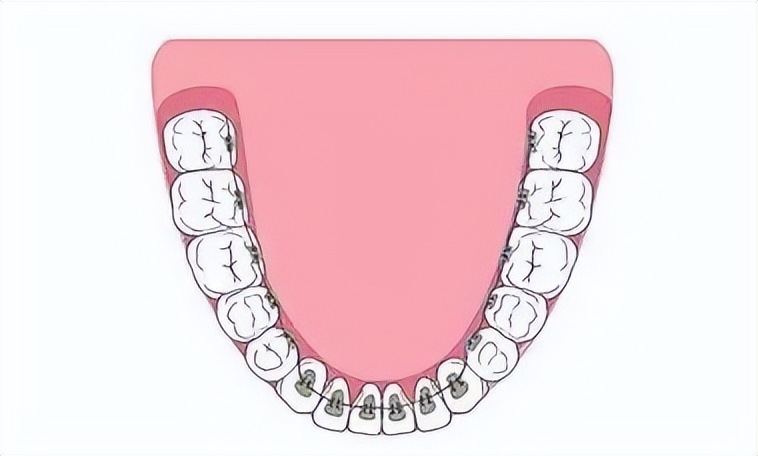 一颗牙长歪矫正要花多少钱,14岁牙歪了怎么自己矫正