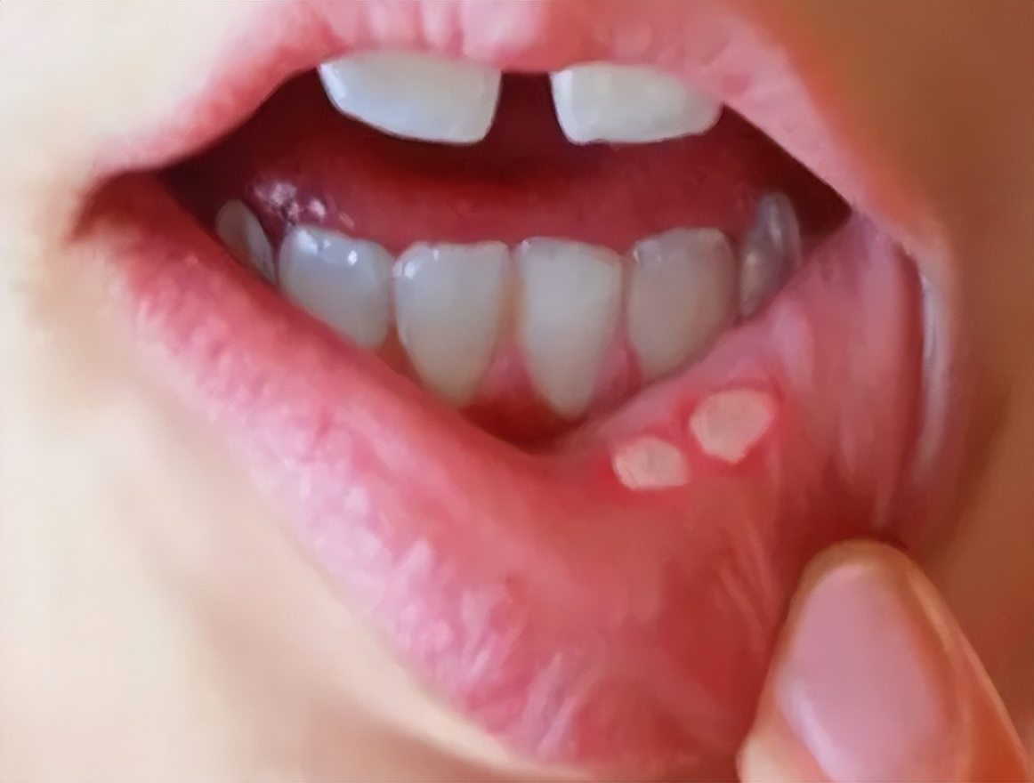 口腔溃疡到底是怎么回事,感冒后口腔溃疡怎么回事