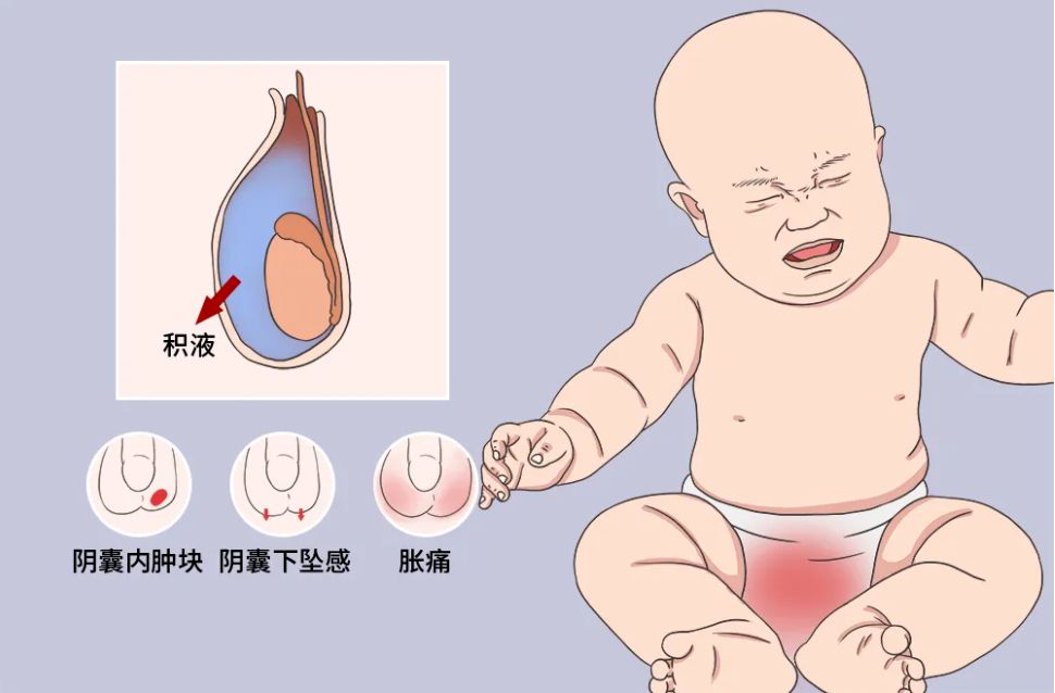 省妇幼鞘膜积液,洛阳妇幼保健院鞘膜积液微创