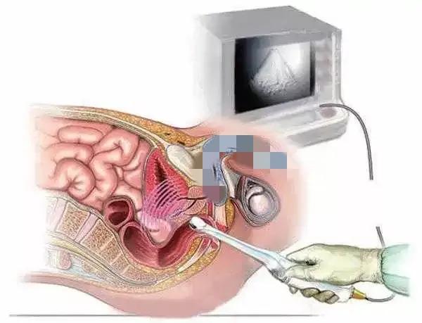 慢性非细菌性前列腺炎西医如何治疗？