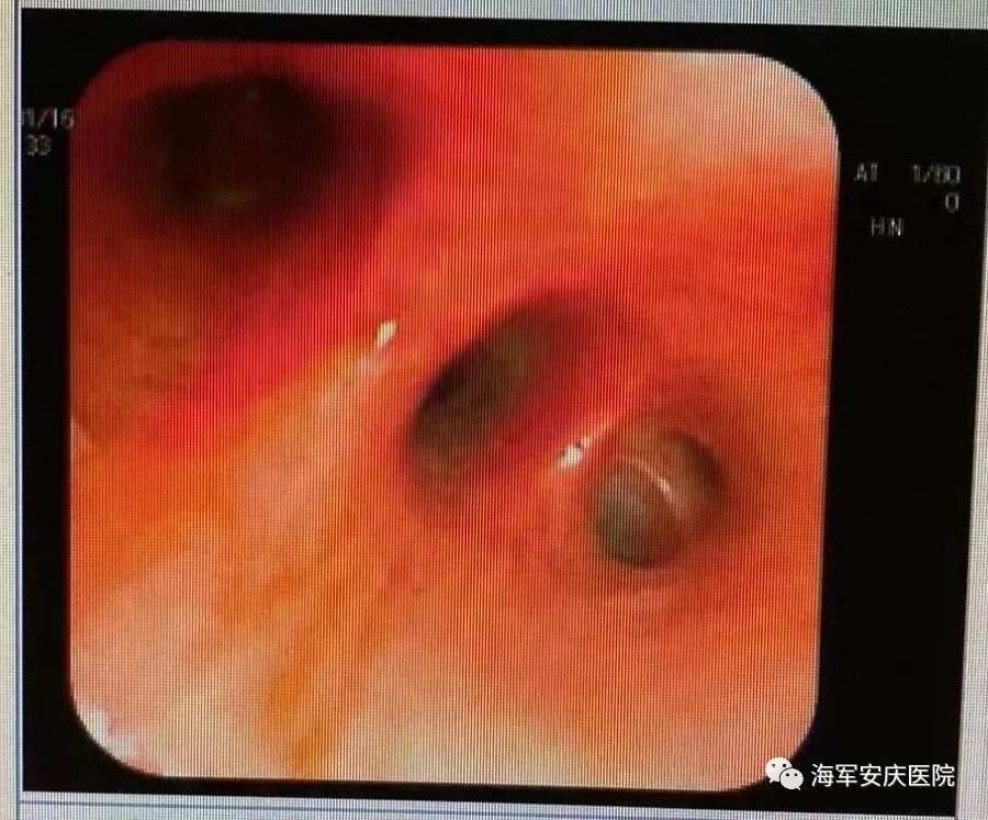 为何阳康后仍觉胸闷气短有痰,阳康后胸闷是什么感觉