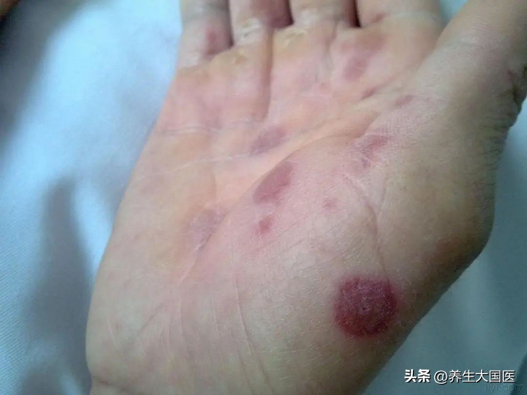 吃药起了很多药疹怎么办,吃药引起的药疹消除方法