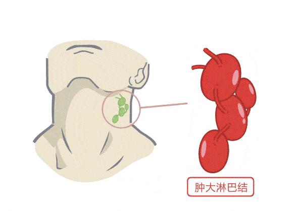 鼻塞鼻涕里带血是什么原因,鼻塞由黄涕转清涕