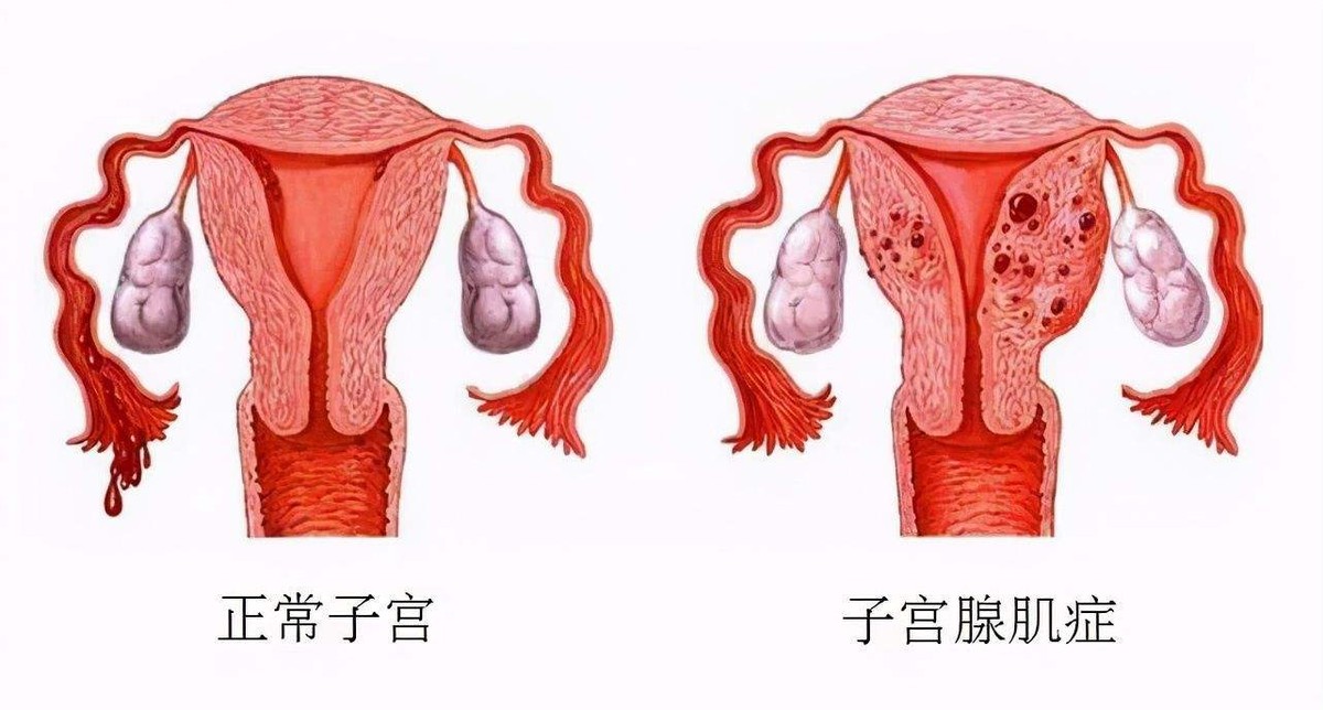 子宫腺肌症究竟是什么病你知道么,你所不了解的子宫腺肌症