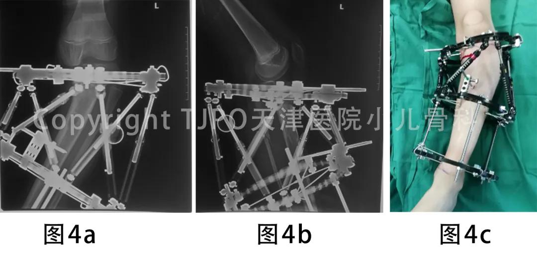 病例分享｜泰勒外固定支架逐渐矫正胫骨近端内翻伴短缩畸形