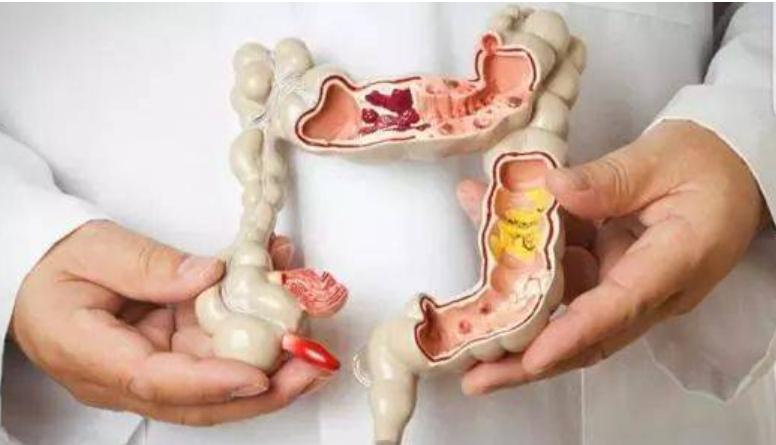 结肠息肉切除止血有哪些方法,直肠息肉切除术止血方法