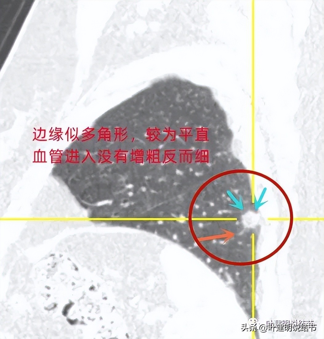 肺结节实性为什么建议抗炎治疗,肺上实性结节抗炎后变成空洞