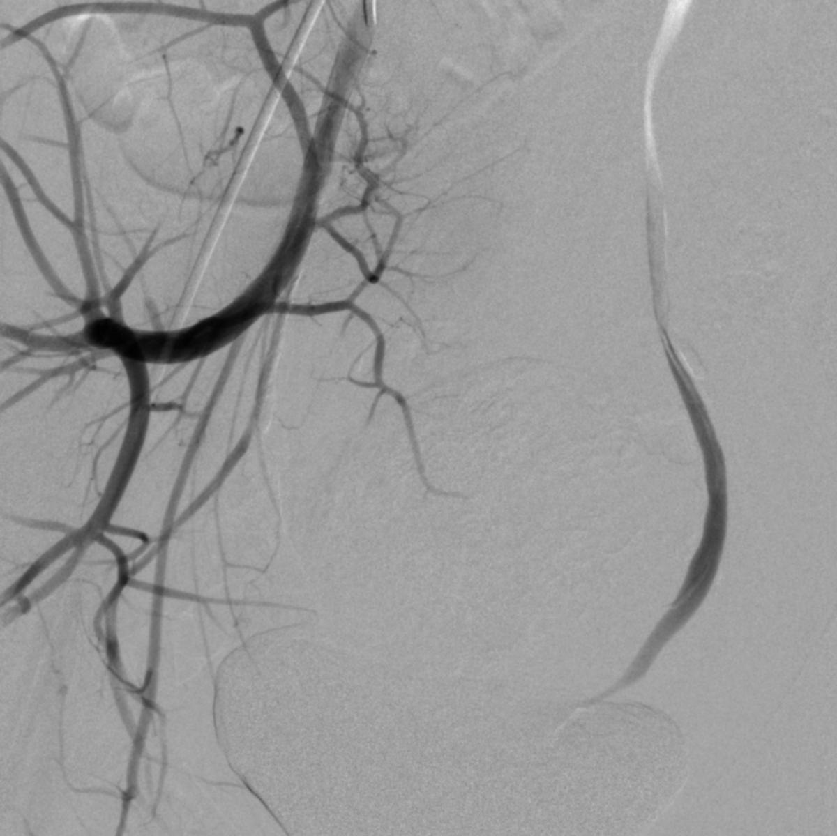 14岁女孩非经期出血,14岁女孩非月经期出血是怎么回事