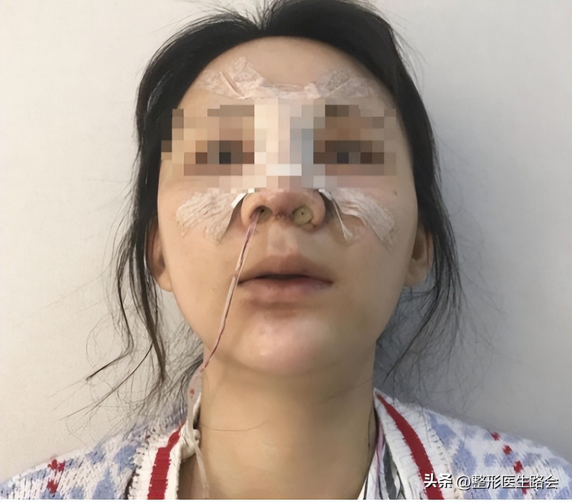 花了几万块钱做的鼻子,花上百万做鼻子