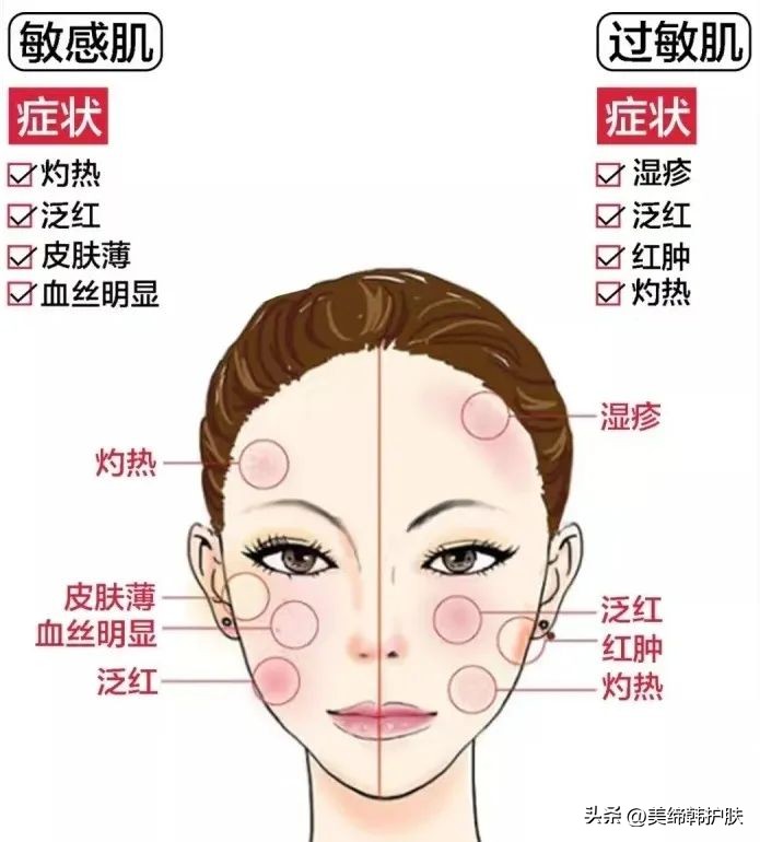 红血丝敏感肌夏天怎么护肤,敏感肌的正确护肤方法