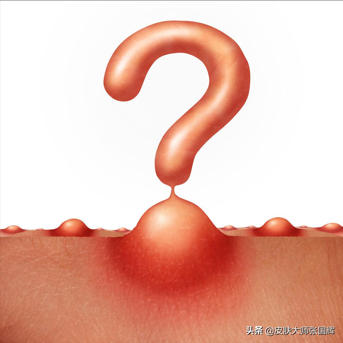 各种痘痘类型及治疗方法,各种痘痘类型治疗方法