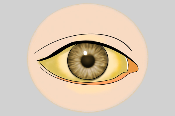 检查发现这五种疾病无需过度治疗,检查出有肝病怎么办