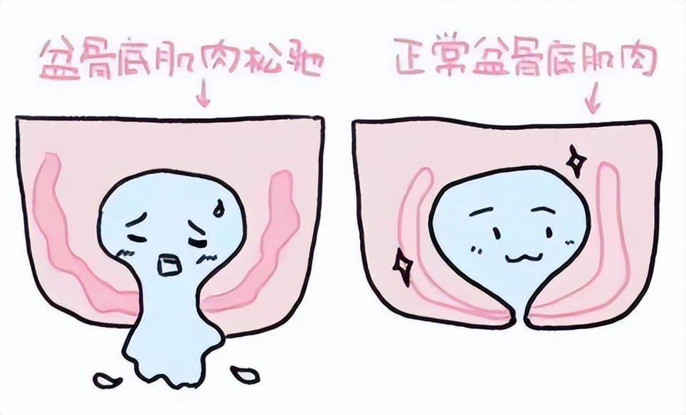 你听说过“笑尿了”吗？谈谈那些被“尿尿”问题所带来的困扰！