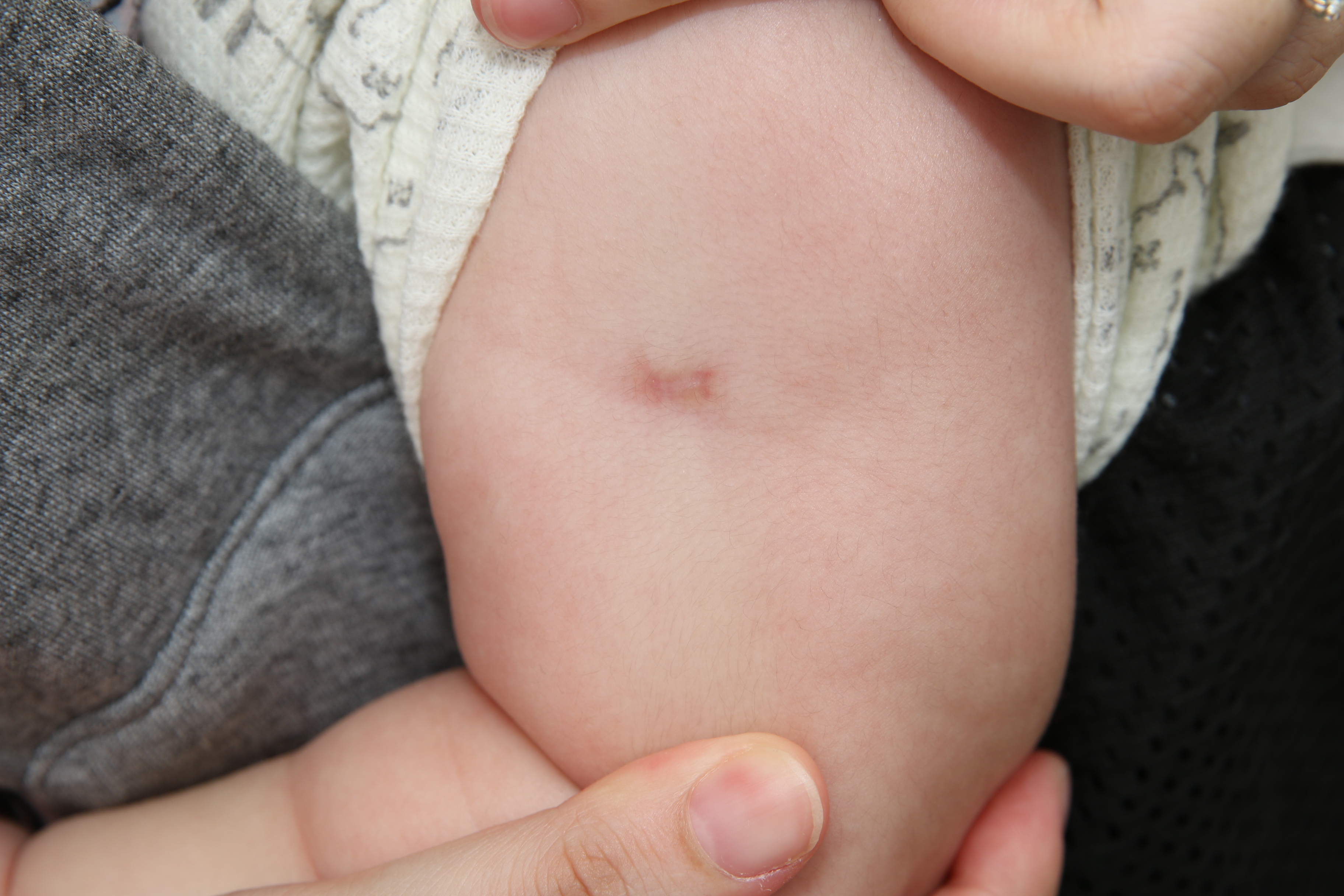 卡介苗接种后不良反应,婴儿打卡介苗有什么不良反应