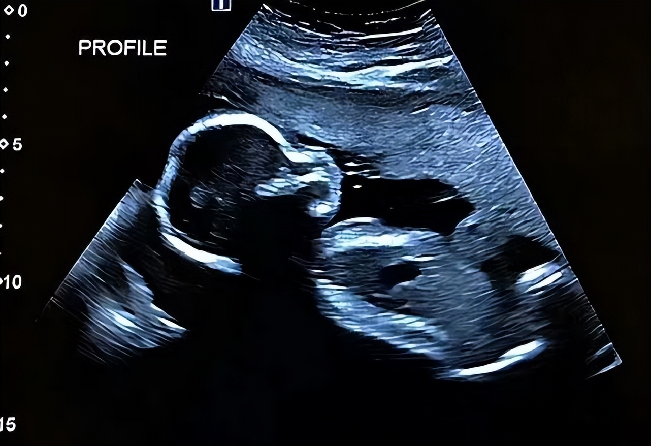 袖珍人梁小小刚刚出生的样子,袖珍女孩梁小小现在长大的样子