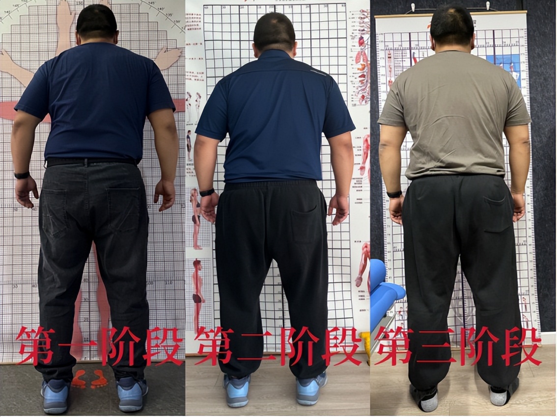 脊柱侧弯有失败的案例吗,脊柱侧弯今日案例分享