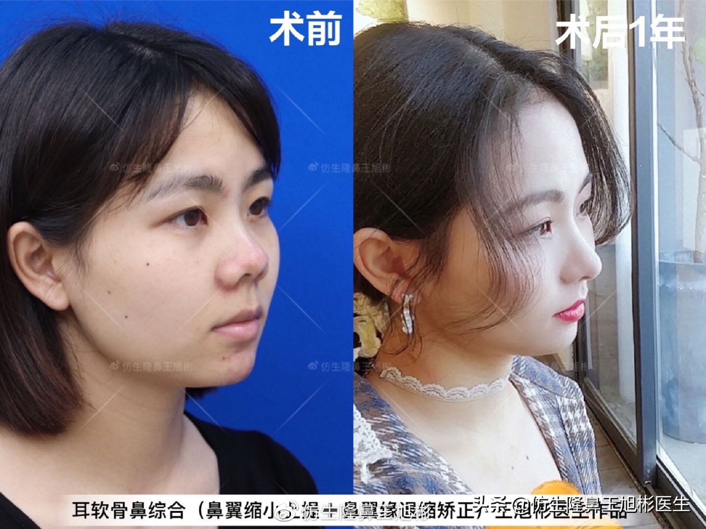 常见鼻部整形美容项目,整形鼻和自然鼻