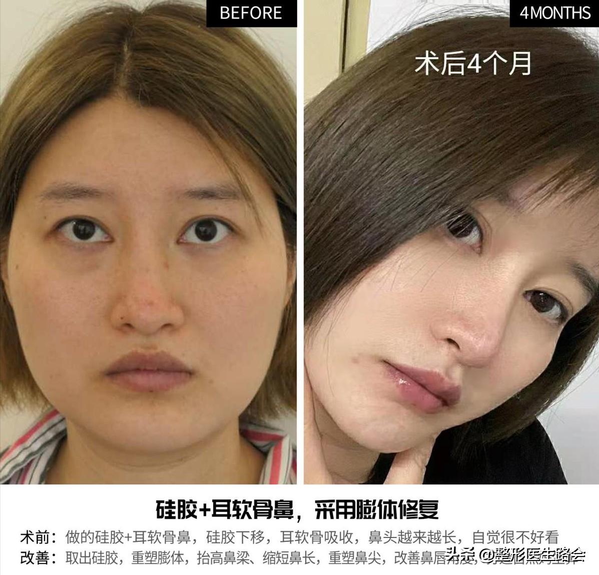 隆鼻手术全过程女生,隆鼻手术到底是怎么进行的