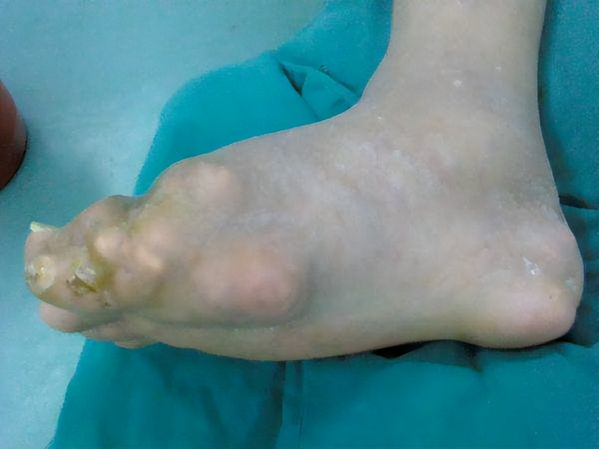 重庆市痛风专家高锋,高锋医生