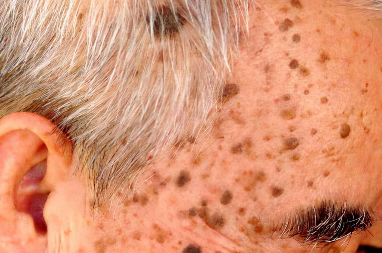 红霉素淡化老人斑的办法,老人斑去除方法红霉素