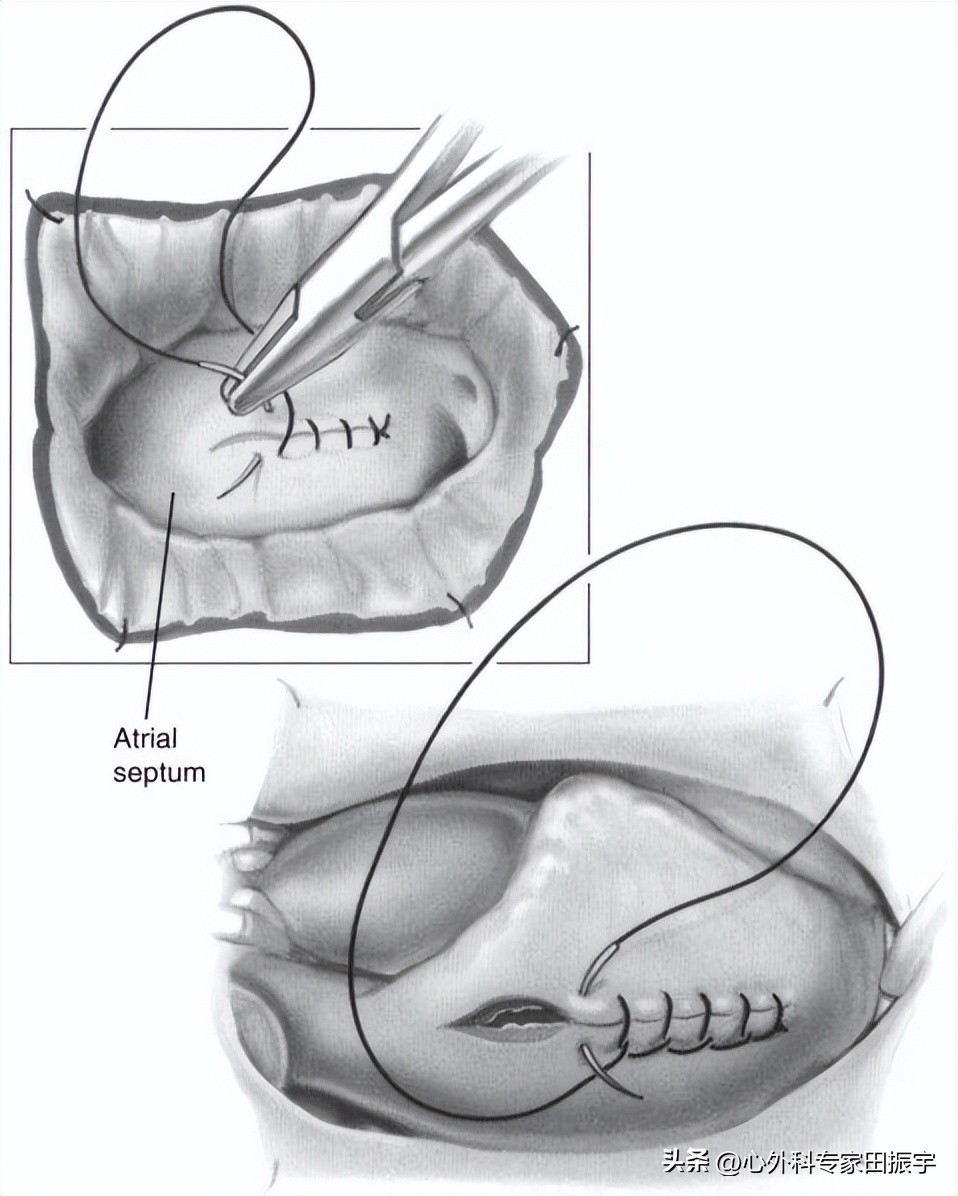 二尖瓣成形术要多少钱,二尖瓣成形术后抗凝多久