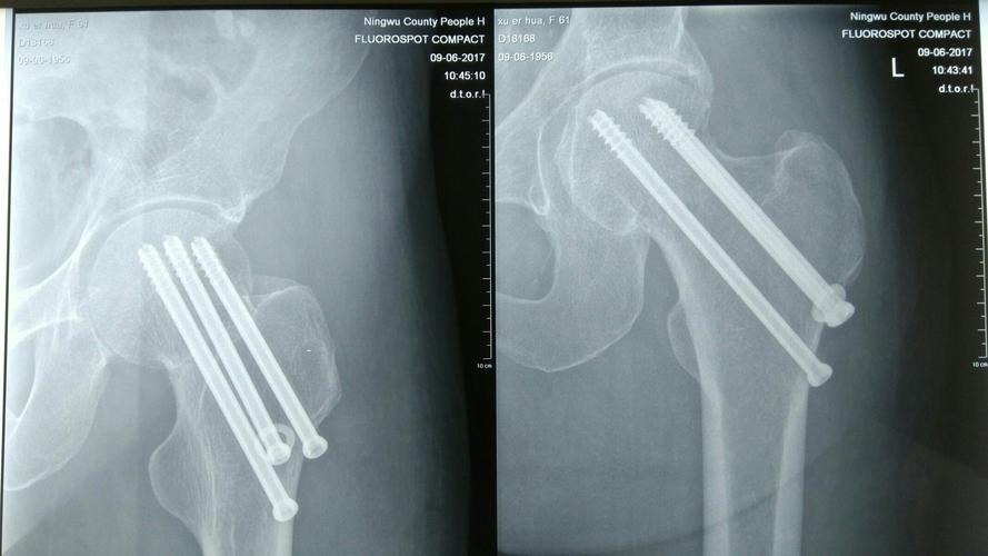 股骨颈骨折矫正仪器,骨科机器人好用吗