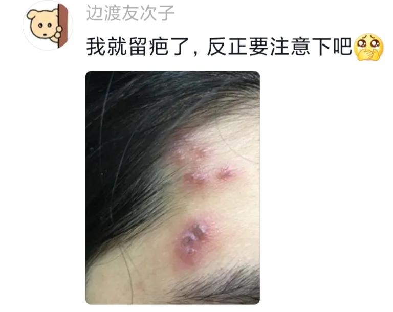 被隐翅虫毁容会好吗,隐翅虫脸上毁容