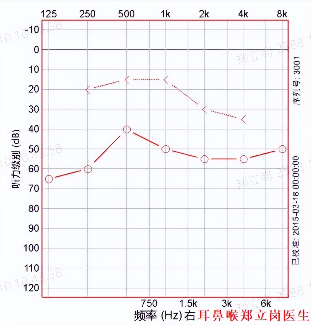 中耳炎为什么要做鼻中隔手术,中耳炎为什么要做手术