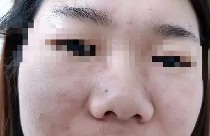 面部皮炎的症状和治疗方法,面部皮炎是怎么回事