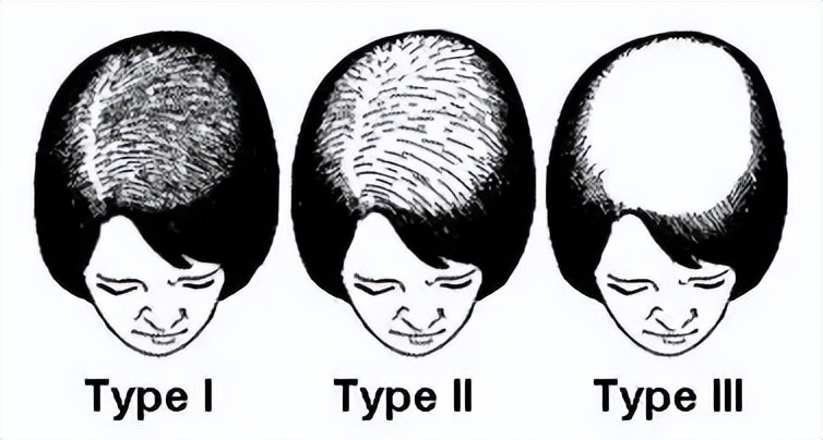 儿童掉头发掉得厉害是什么原因,女生头发掉得厉害是什么原因