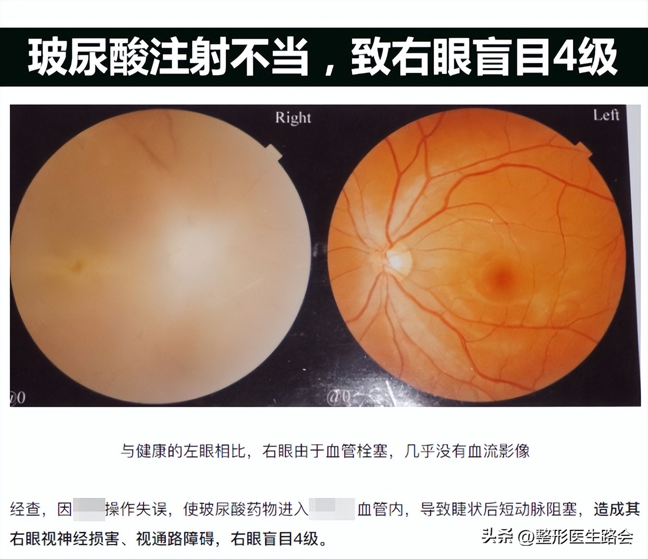 玻尿酸隆鼻立竿见影吗,玻尿酸隆鼻适合哪些鼻型