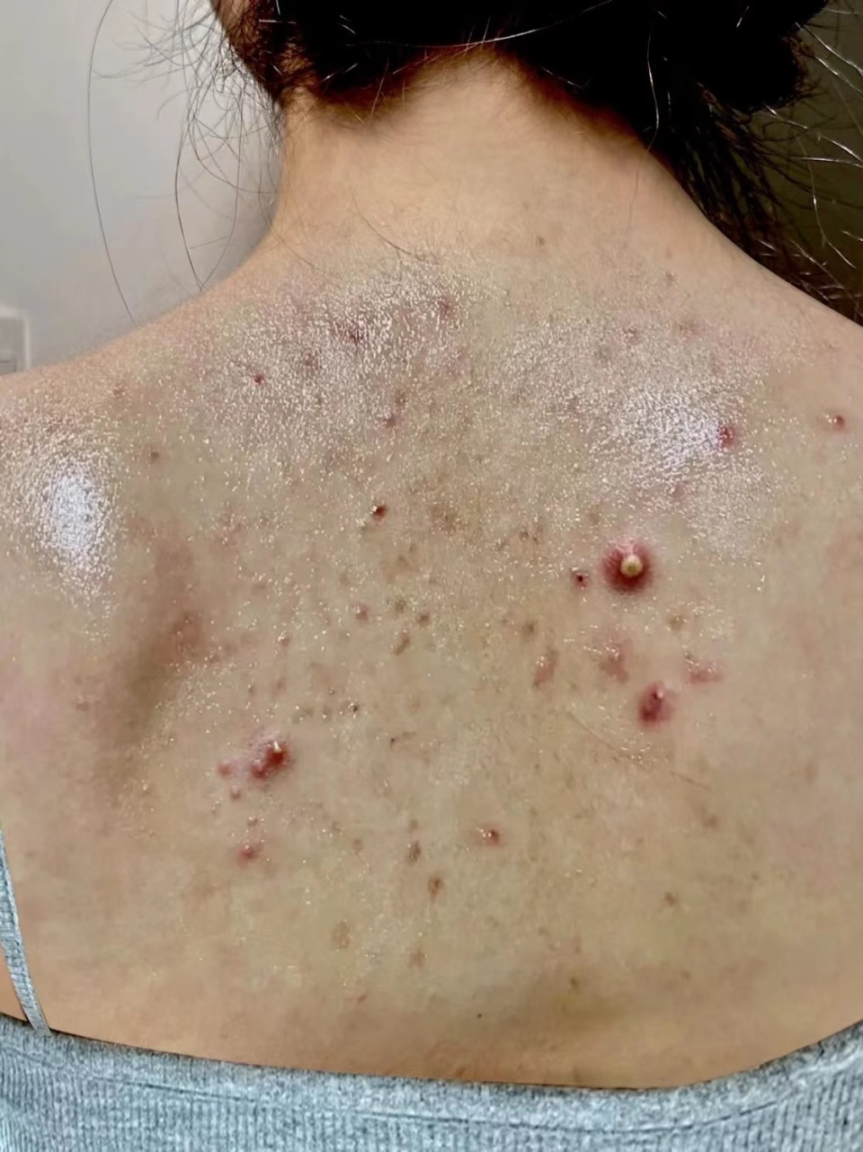 祛痘去痘印除螨沐浴露,沐浴露除螨祛痘改善鸡皮肤