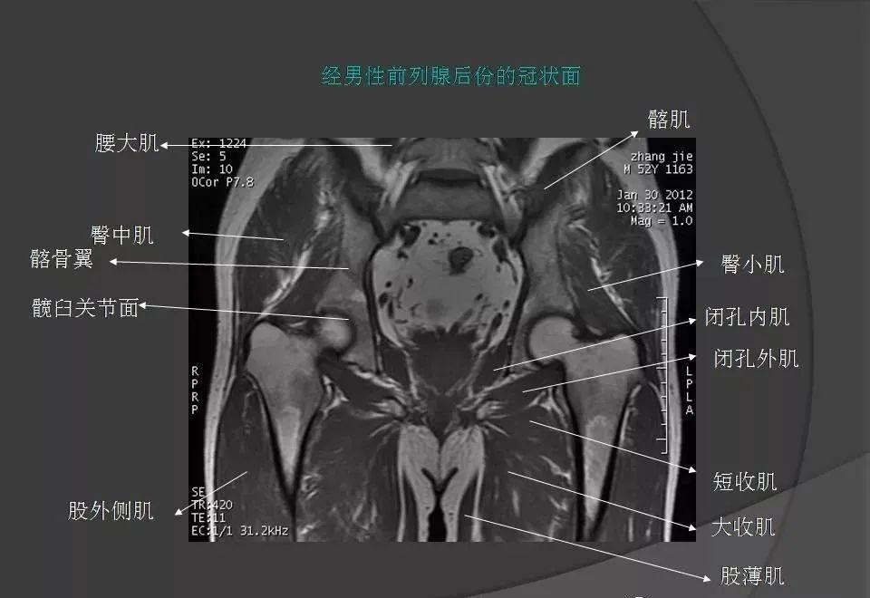 女性盆腔ct连续断层解剖图,盆腔mri影像病例分析